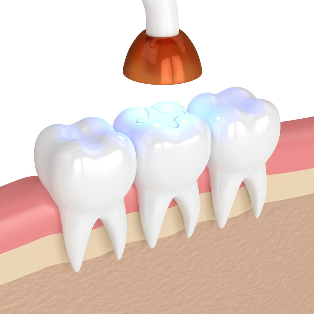 graphic for a tooth filling